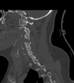 Chordoma (C4 vertebra) (Radiopaedia 47561-52188 Sagittal bone window 52).png