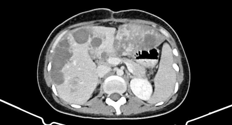 File:Choriocarcinoma liver metastases (Radiopaedia 74768-85766 A 76).jpg