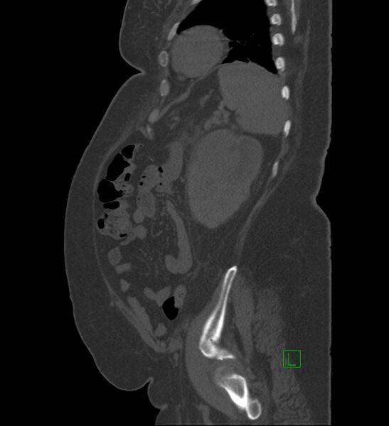 File:Chromophobe renal cell carcinoma (Radiopaedia 84239-99519 Sagittal bone window 22).jpg