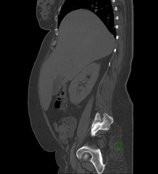 File:Chromophobe renal cell carcinoma (Radiopaedia 84239-99519 Sagittal bone window 76).jpg