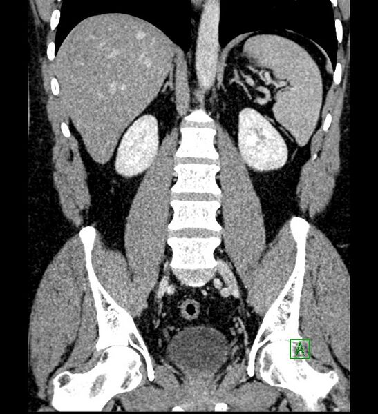 File:Chromophobe renal cell carcinoma (Radiopaedia 84286-99573 H 115).jpg