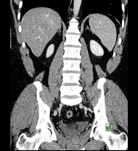 File:Chromophobe renal cell carcinoma (Radiopaedia 84286-99573 H 123).jpg