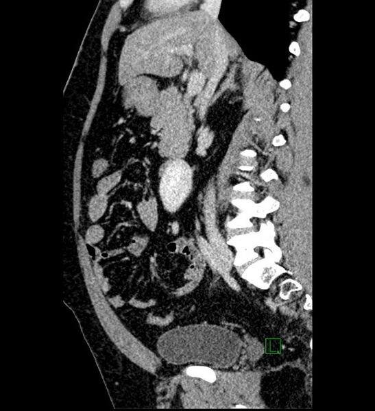 File:Chromophobe renal cell carcinoma (Radiopaedia 84286-99573 I 106).jpg