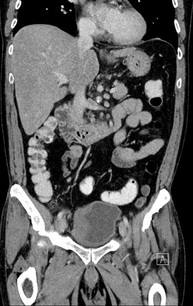 File:Chronic appendicitis complicated by appendicular abscess, pylephlebitis and liver abscess (Radiopaedia 54483-60700 C 37).jpg