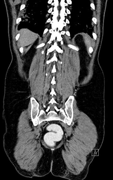 File:Chronic appendicitis complicated by appendicular abscess, pylephlebitis and liver abscess (Radiopaedia 54483-60700 C 69).jpg