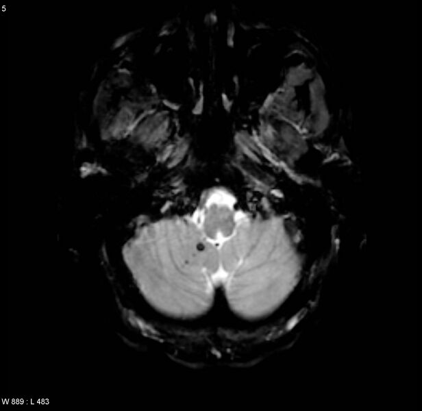 File:Chronic hypertensive encephalopathy (Radiopaedia 4564-6686 Axial Gradient Echo 1).jpg
