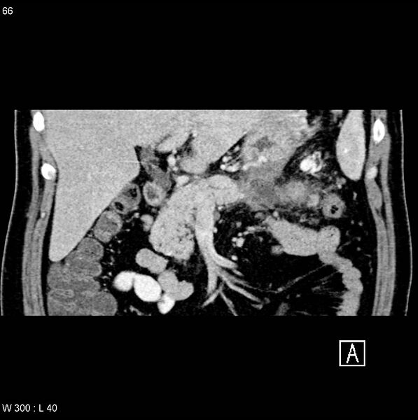 File:Chronic pancreatitis and pseudocysts (Radiopaedia 6724-7935 C 5).jpg