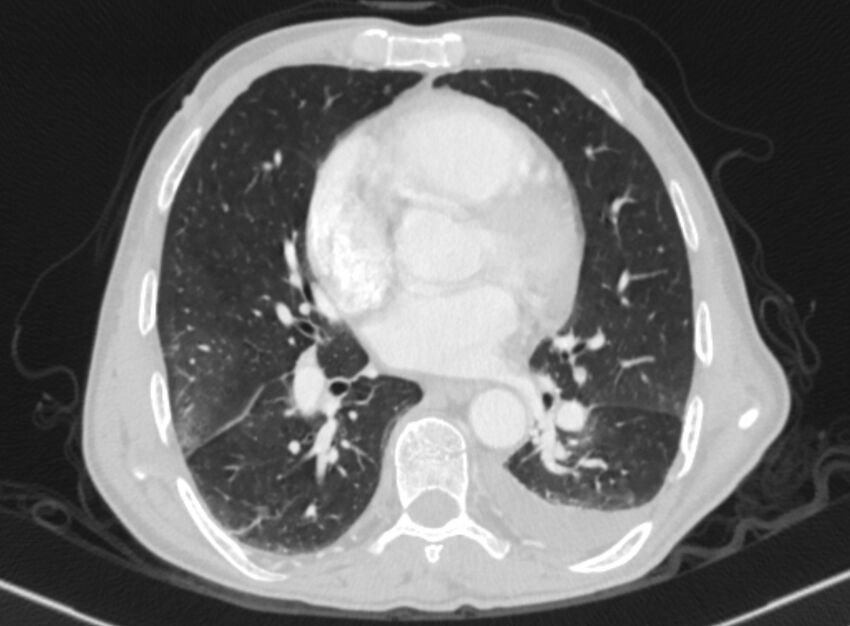 Chronic pulmonary embolism with bubbly consolidation (Radiopaedia 91248-108850 Axial lung window 93).jpg