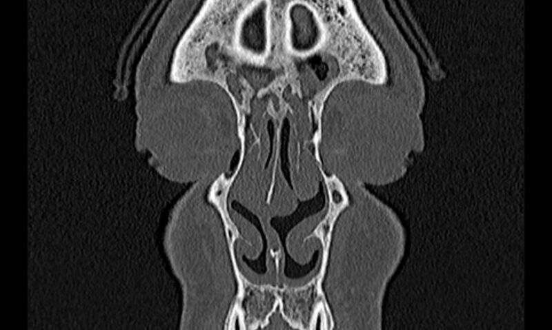 File:Chronic rhinosinusitis (Radiopaedia 65079-74075 Coronal bone window 10).jpg