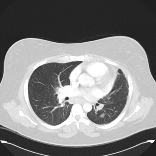 File:Chronic thromboembolic pulmonary hypertension (CTEPH) (Radiopaedia 74597-85531 Axial lung window 26).jpg