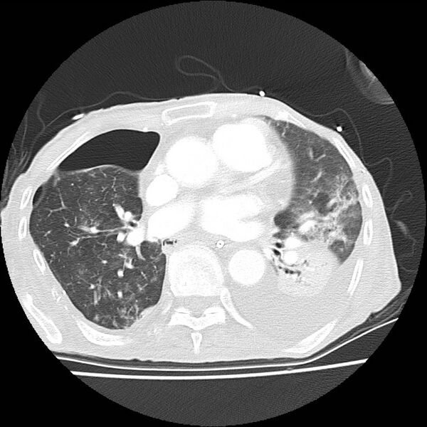 File:Clagett thoracotomy with bronchopleural fistula (Radiopaedia 29192-29587 Axial lung window 27).jpg