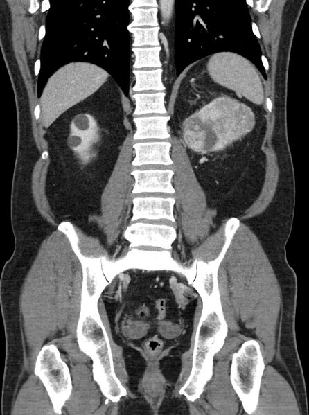 File:Clear cell renal cell carcinoma (Radiopaedia 61449-69393 F 36).jpg