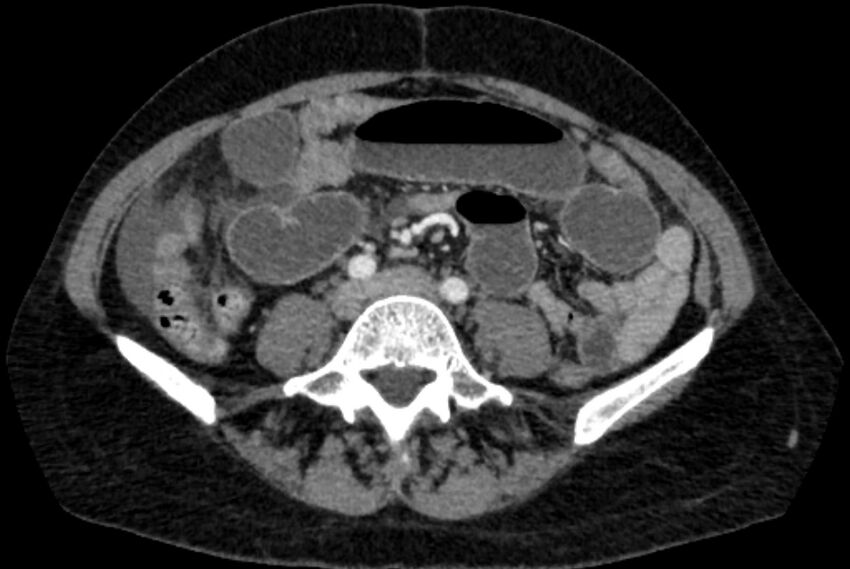 Closed loop small bowel obstruction (Radiopaedia 71211-81508 A 81).jpg