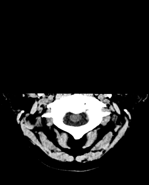 File:Colloid cyst of the third ventricle (Radiopaedia 86571-102661 Axial non-contrast 3).png