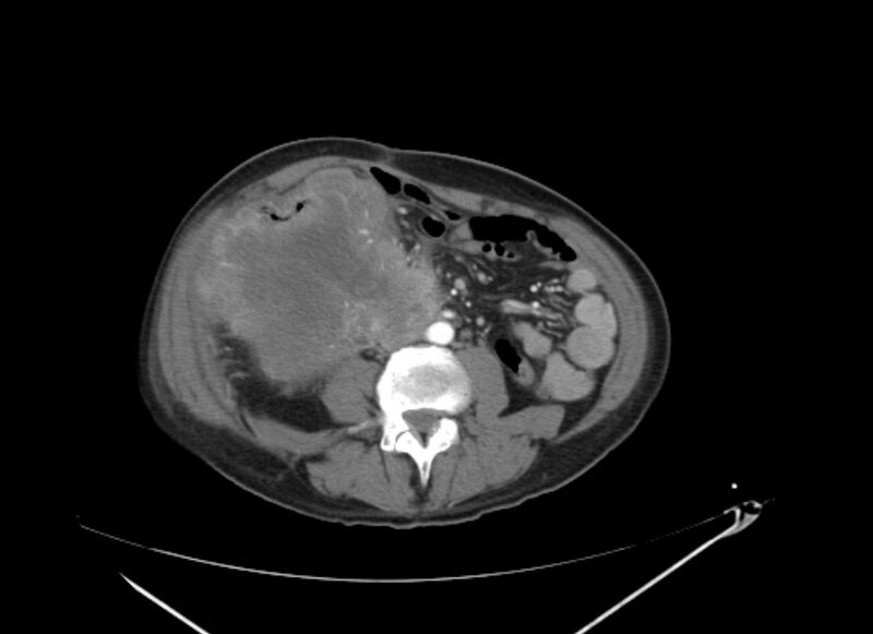 File:Colon cancer mimicking renal cell carcinoma (Radiopaedia 28986-29335 B 44).jpg
