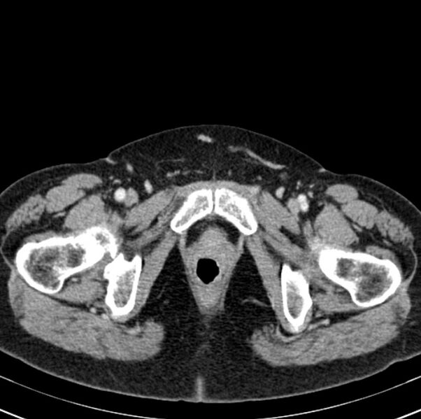 File:Colon carcinoma with hepatic metastases (Radiopaedia 29477-29961 A 117).jpg