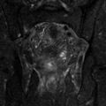 Colonic fistula (Radiopaedia 16047-15708 Coronal T2 fat sat 30).jpg