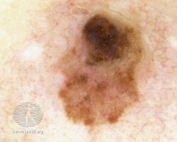 Dermoscopy of nodular melanoma arising within a superficial spreading melanoma