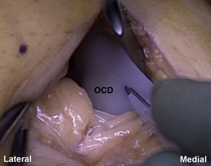 The articular cartilage along the border of the osteochondritis dissecans lesion