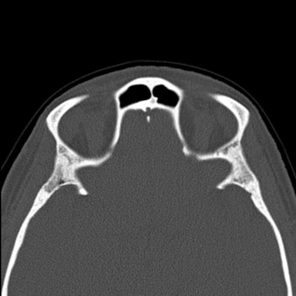 File:Nasal septal perforation (Radiopaedia 25030-25289 Axial bone window 56).jpg