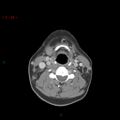 Nasopharyngeal lymphoma (Radiopaedia 54235-60433 A 12).jpg