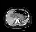 Necrotizing pancreatitis (Radiopaedia 23001-23031 A 20).jpg