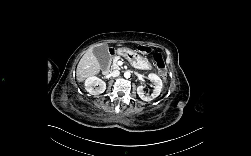 Neo-terminal ileal stricture (Crohn disease) (Radiopaedia 33790-34948 A 157).jpg