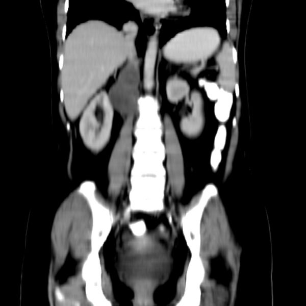File:Neurofibroma - spine (Radiopaedia 27891-28125 B 18).jpg