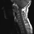 Neurofibromatosis type 1 (Radiopaedia 80355-93740 Sagittal T1 3).jpg