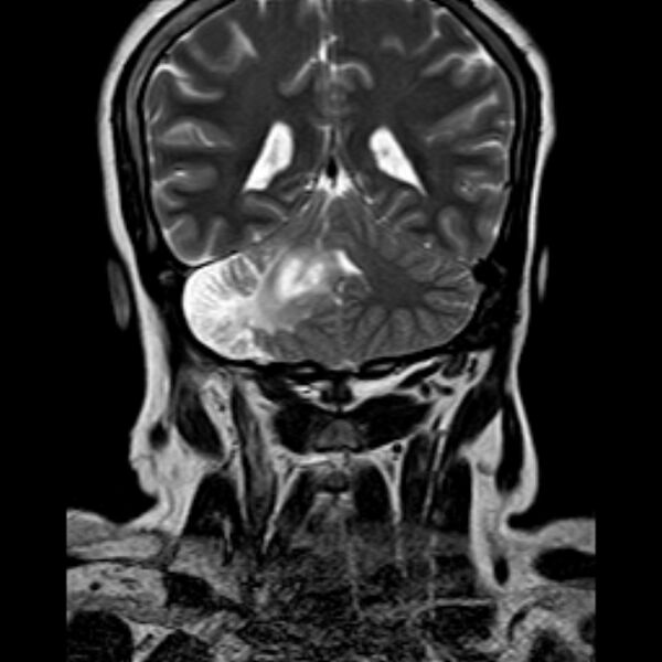 File:Neurofibromatosis type 2 (Radiopaedia 67470-76871 Coronal T2 17).jpg