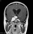 Neurofibromatosis type 2 - cranial and spinal involvement (Radiopaedia 5351-7111 Coronal T1 C+ 3).jpg