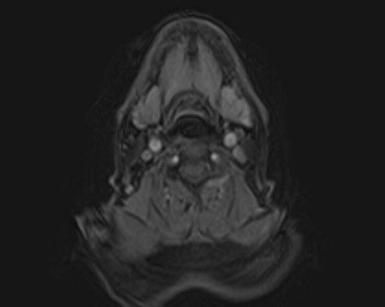 File:Non-Hodgkin lymphoma - parotid gland (Radiopaedia 71531-81890 E 1).jpg