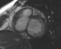 Non-compaction of the left ventricle (Radiopaedia 69436-79314 Short axis cine 170).jpg