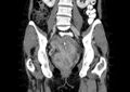 Non-puerperal uterine inversion (Radiopaedia 78343-91094 B 21).jpg