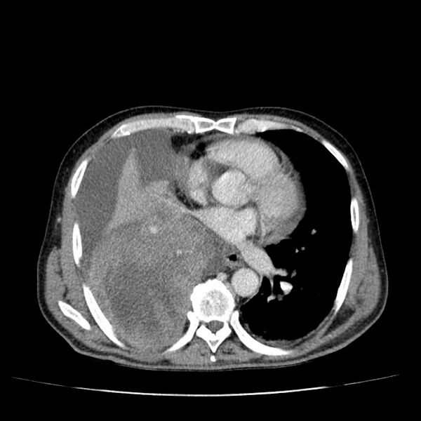 File:Non small-cell lung cancer (Radiopaedia 24467-24769 C+ delayed 36).jpg