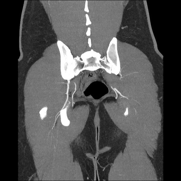 File:Normal CT angiogram of pelvis (Radiopaedia 45390-49430 B 37).jpg