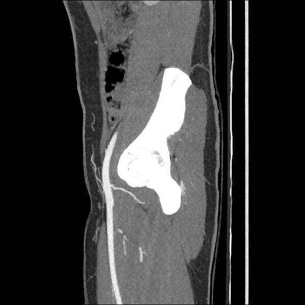 File:Normal CT angiogram of pelvis (Radiopaedia 45390-49430 C 22).jpg