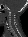 Normal CT cervical spine - pediatric (Radiopaedia 52549-58462 Sagittal bone window 112).jpg