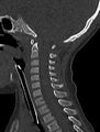 Normal CT cervical spine - pediatric (Radiopaedia 52549-58462 Sagittal bone window 97).jpg