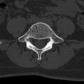 Normal CT lumbar spine (Radiopaedia 53981-60118 Axial bone window 58).jpg