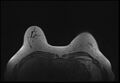 Normal breast MRI - dense breasts (Radiopaedia 80454-93850 Axial T1 45).jpg