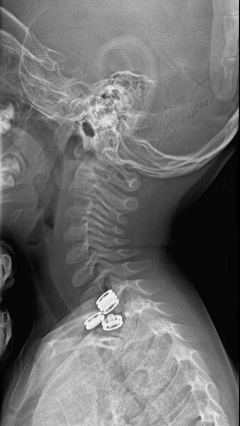 File:Normal cervical spine radiographs - 2-year-old (Radiopaedia 53360-59340 Lateral 1).jpeg