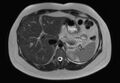 Normal liver MRI with Gadolinium (Radiopaedia 58913-66163 Axial T2 22).jpg