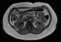 Normal liver MRI with Gadolinium (Radiopaedia 58913-66163 B 12).jpg
