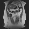 Normal liver MRI with Gadolinium (Radiopaedia 58913-66163 Coronal T2 11).jpg