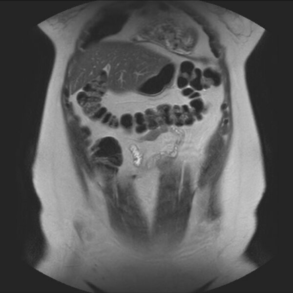 File:Normal liver MRI with Gadolinium (Radiopaedia 58913-66163 Coronal T2 11).jpg