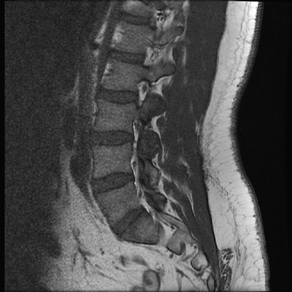 File:Normal lumbar spine MRI (Radiopaedia 43051-46311 Sagittal T1 14).jpg