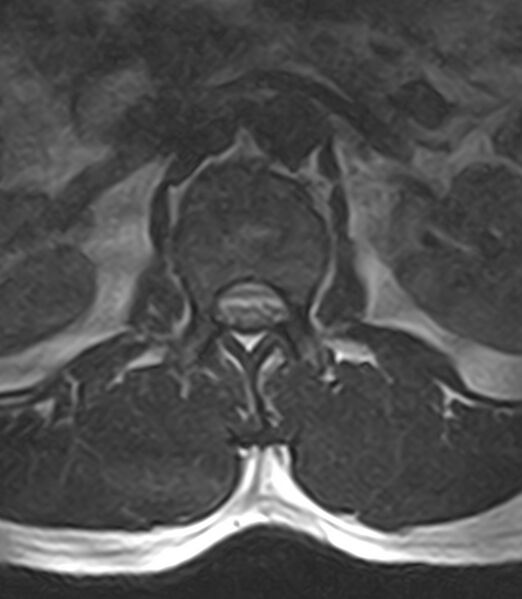 File:Normal lumbar spine MRI - low-field MRI scanner (Radiopaedia 40976-43699 Axial T2 23).jpg