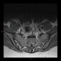 Normal spine MRI (Radiopaedia 77323-89408 Axial T1 30).jpg