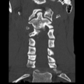 Normal trauma cervical spine (Radiopaedia 41017-43760 Coronal bone window 18).png